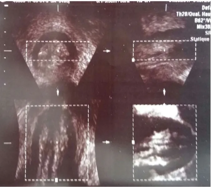 Figure N° 2 : Echographie pélvi-périnéale 4D montrant : Nodule arrivant au contact du  sphincter externe de l’anus au-dessous de la cicatrice d’épisiotomie 