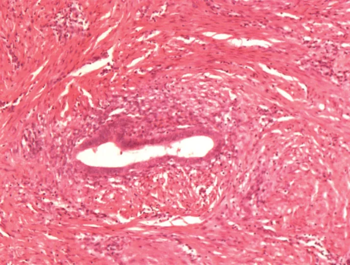 Figure N° 12 : Coupe histologique d’une glande endométriale (H&amp;E * 100) [4]¨ 