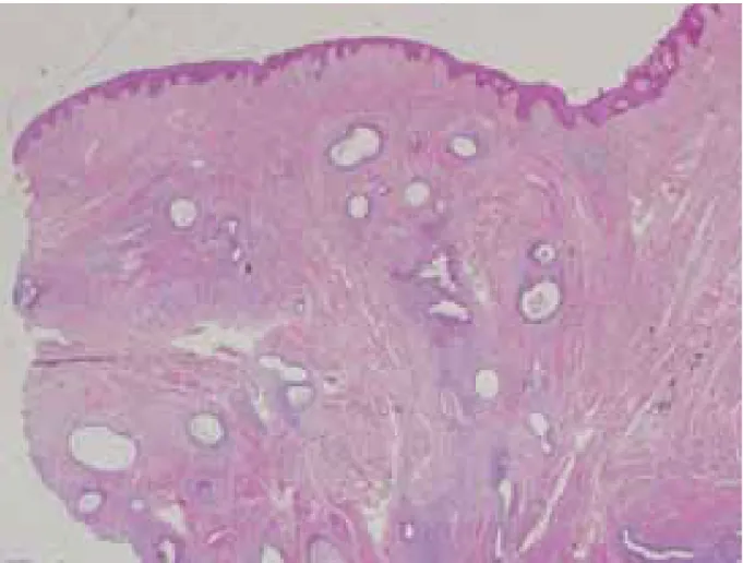 Figure N°13 : Coupe histologique d’une glande endométriale   et son stroma dans l’épithélium vulvaire [119] 
