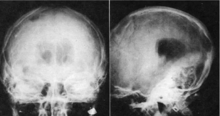 Figure 3: Pneumoencéphalographie du premier patient vivant souffrant 