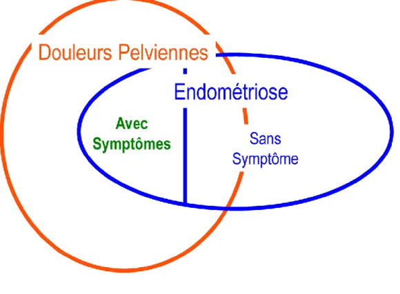 Figure 4 : Modèle de relation entre endométriose et algies pelviennes   chroniques, d’après Hurd et al