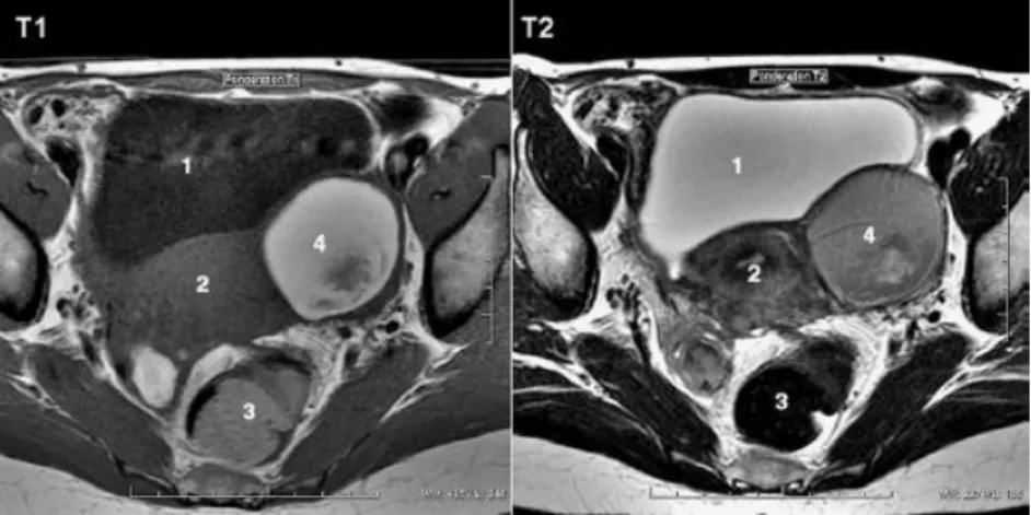Figure 9 : Coupe axiale d’IRM comparant le signal en T1 et T2 au sein d’un  endométriome