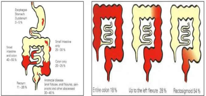 Figure  10 : Localisation des atteintes intestinales dans la MC et la RCH [39] 