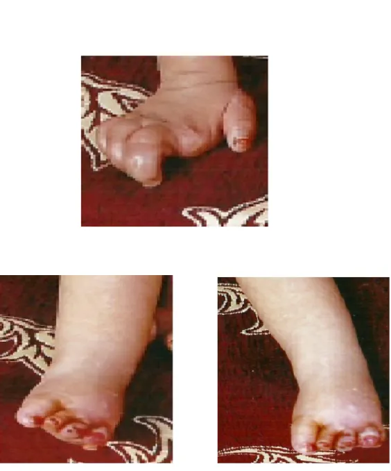 Figure 22 : dystrophie unguéale au niveau des mains et des pieds 