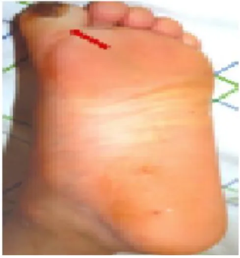 Figure 13 : mal perforant plantaire au niveau du pied droit 