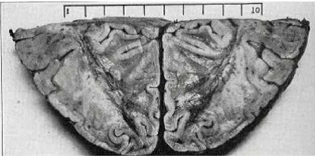 Figure  10  :  Sections  horizontales  des  lobes  occipitaux  (nourrisson  décédé  à  l’âge  de  16  mois  et  demi)