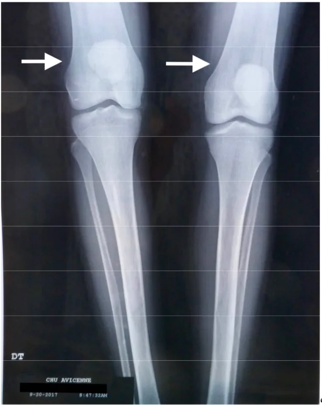 Figure 2 : Radiographie standard des genoux de face objectivant une déformation des  fémurs en flacon d’Erlenmeyer.