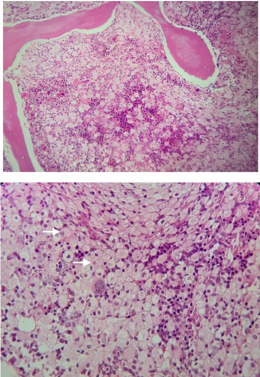 Figure 4 : Biopsie ostéo-médullaire objectivant des espaces ostéo-médullaires  infiltrés par des nappes d’histiocytes au cytoplasme lamellaire et aux noyaux   refoulés en périphérie (cellules de Gaucher)