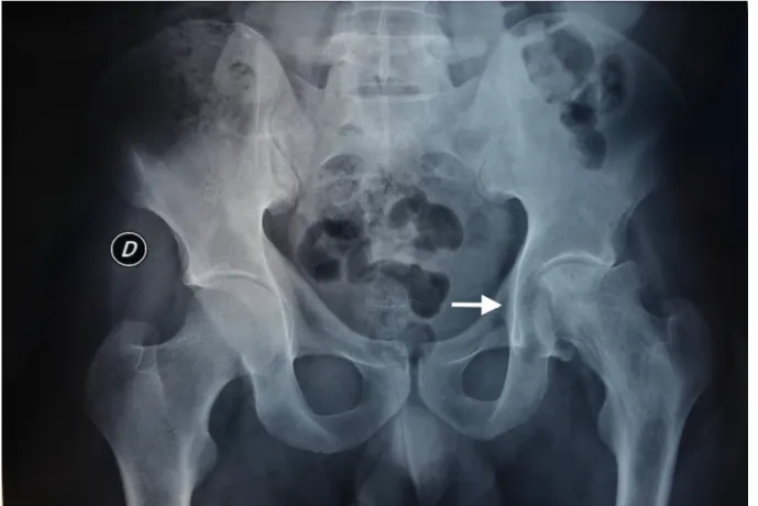 Figure 6 : Radiographie du bassin de face objectivant une ostéonécrose   de la tête fémorale gauche