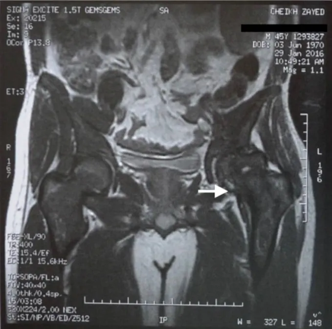 Figure 8 : IRM du bassin en coupe coronale objectivant une nécrose   aseptique de la tête fémorale gauche