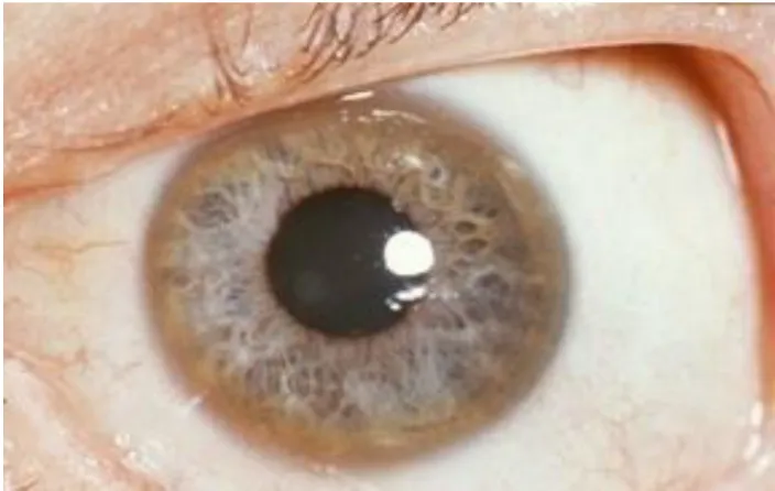 Figure 7: anneau de Kayser-Fleischer [73]. 