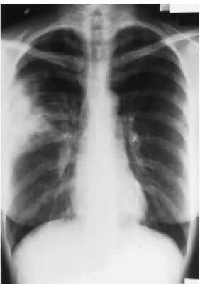 Figure VI : Radiographie du thorax montrant la condensation du lobe  supérieur droit le jour de l'admission [366]