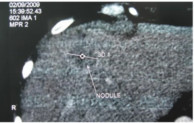 Fig .5: TDM montrant une métastase hépatique unique 