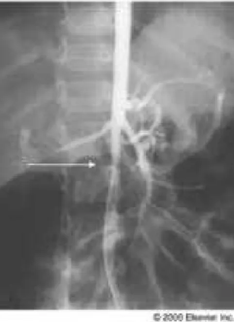 Figure 14 : Image aortographique montrant une coarctation de l’aorte abdominale chez un  patient ayant une hypertension artérielle dans le cadre de la neurofibromatose  de type 1