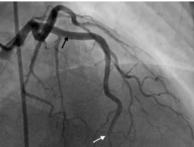 Figure 16 :  Dissection proximale de l’artère inter ventriculaire (flèche noire), et occlusion  total du vaisseau en distalité [154]
