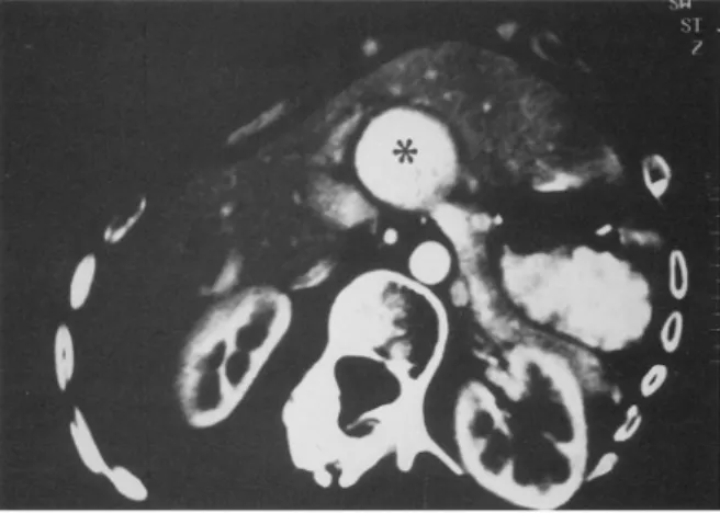 Figure 17 : Coupe scannographique passant par l’abdomen montrant un large anévrysme de  l’artère hépatique (étoile) [162]
