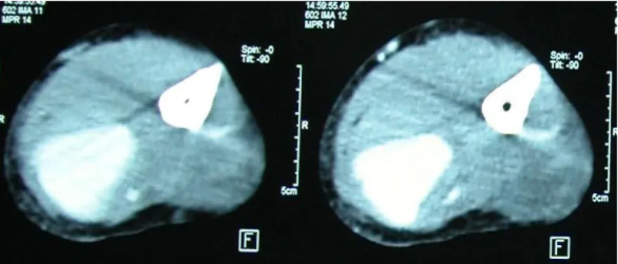 Figure 5 : Radiographies pulmonaires (face et profil)   montrant l’opacité apicale gauche chez notre patiente 