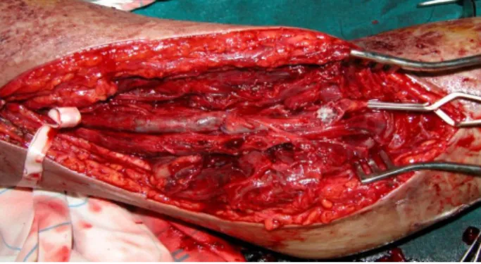Figure 9 : Aspect per opératoire de l’artère humérale, après mise   à plat du faux anévrysme chez notre patiente