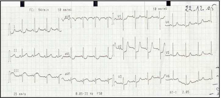 Figure n°2 : ECG à l’admission: sus décalage du segment ST en postéro-  inférieur et sous décalage du segment ST en antéro- latéral