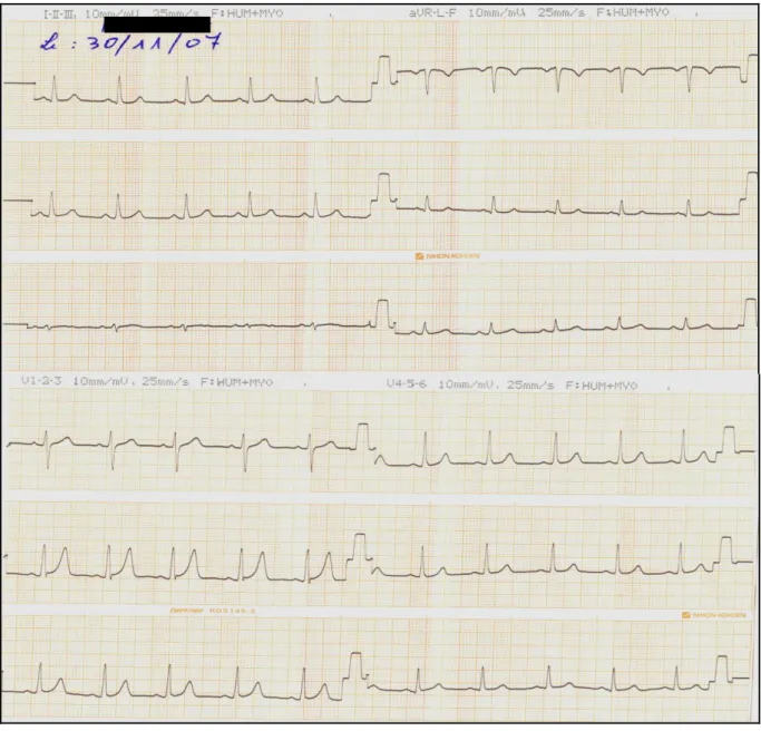 Figure n°4 : ECG de contrôle: normalisation des signes électriques 