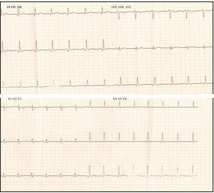 Figure n°.12: ECG montrant un rythme régulier sinusal à 75 cycles/min, un axe  QRS en D2, un PR à 0.16s, sans anomalie du QRS ni troubles de repolarisation