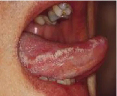 Figure 12 : Leucoplasie orale chevelue.  (65) 