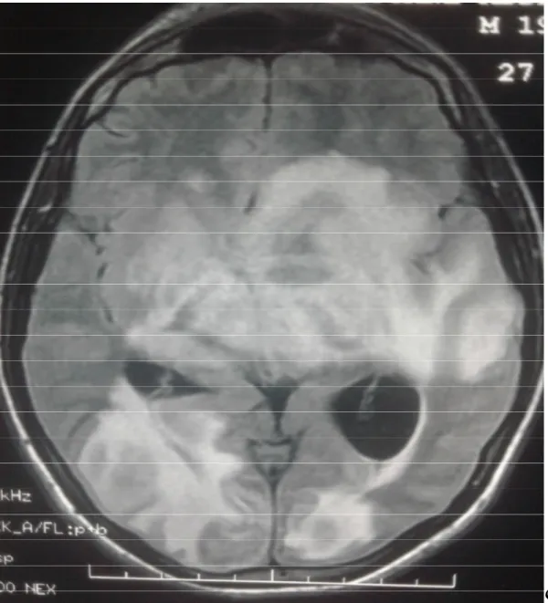 Figure n 0 6 : IRM cérébrale séquence T1 d’un patient de 19 ans montrant de  multiples lésions cérébrales sus et sous-tentorielles, rehaussées de façon  nodulaire et annulaire après injection de gadolinium, entourées d’importantes  plages d’œdème péri lési