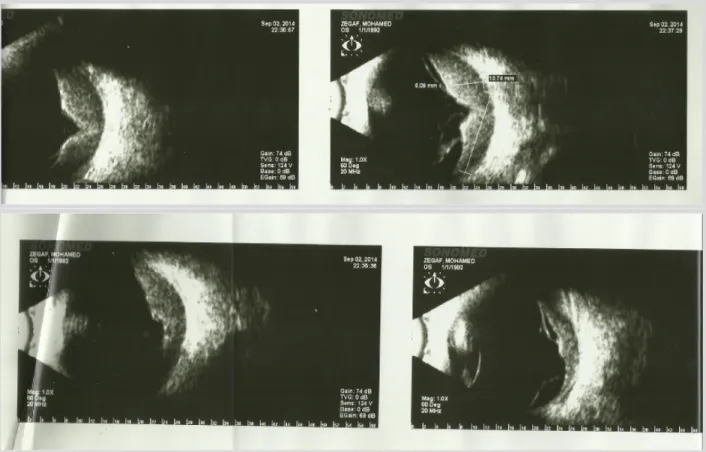 Figure 3 : Echographie oculaire gauche au moment de la rechute oculaire 4 ans et demi  du diagnostic de la maladie et 18 mois de l’arrêt du traitement, montrant un décollement 