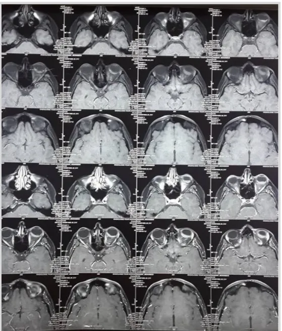 Figure 4: IRM cérébro-orbitaire au moment de la rechute oculaire (coupe transversale) 4 ans  et demi du diagnostic de la maladie et 18 mois de l’arrêt du traitement, ne montrant pas de 