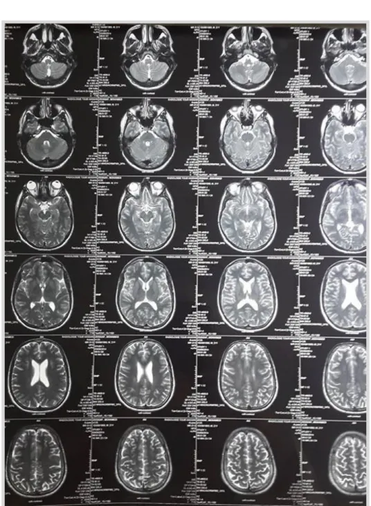 Figure 6: IRM cérébro-orbitaire au moment de la rechute oculaire (coupe transversale)  4 ans et demi du diagnostic de la maladie et 18 mois de l’arrêt du traitement ne montrant pas 
