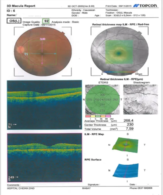 Figure 7 : OCT maculaire OG de contrôle14 mois après la rechute ophtalmologique. 