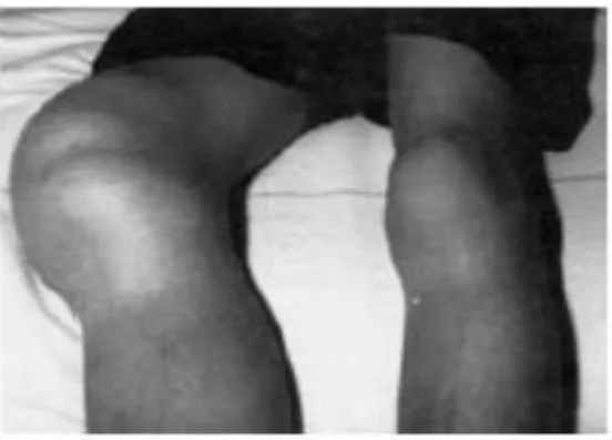 Fig. 1 : Hémarthrose du genou droit  en l’absence de traitement [11]. 