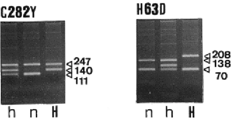Figure 11:  Génotypage  des  mutations  C282Y  et  H63D.  Après  restriction  RsaI  les  bandes peuvent être à 247, 140 et 111 paires de bases (pb) ; après restriction MboI  les  bandes  peuvent  être  à  208,  138  et  70  pb ;  n :  génotype  normal  (+ 