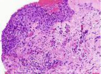 Figure 8: Carcinome conjonctival invasif. 