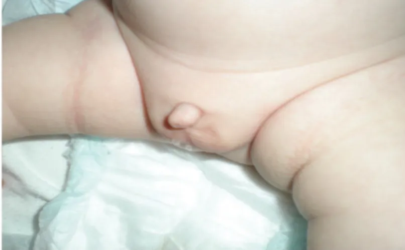 Figure 9 : Micropénis chez un nouveau-né (25)  1.  Circonstance de découverte : 