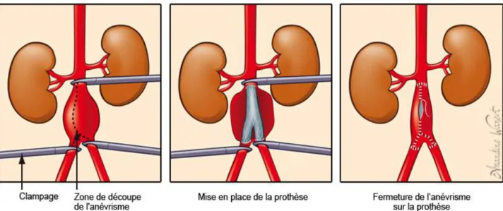 Figure 6 : Principe de la chirurgie conventionnelle de l’anévrisme de l’aorte abdominale sous  rénale 