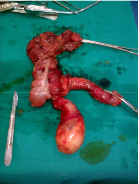 Figure 14: Pièce opératoire d'hémicolectomie droite montrant la mucocèle  appendiculaire géante (Photo Pr Moujahid) 