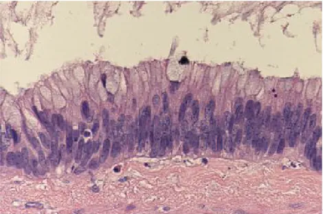 Figure 20: aspect histologique d'un cystadénome mucineux   avec léger pléomorphisme et atypie nucléaire (HES ×20) [90] 