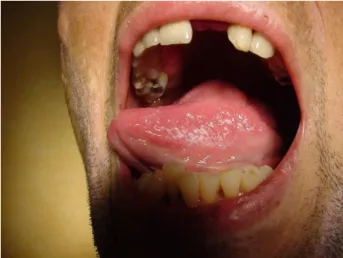 Figure  1 :  Candidose  buccale  avec  atteinte  de  la  langue  [Photos  du  laboratoire  de  Parasitologie Mycologie, Hôpital Militaire d’Instruction Mohammed V] 