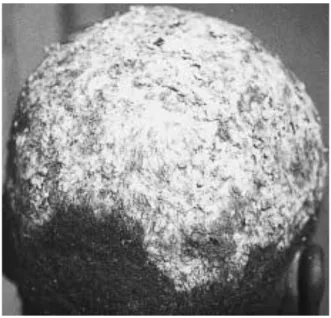 Figure 13 : Teigne favique chez un homme de 22 ans due à Trichophyton  schoenleinii. Les croûtes sont des godets faviques [98] 