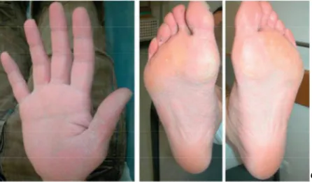 Figure 3: Kératodermie palmoplantaire : syndrome « One hand-two feet » [17]. 