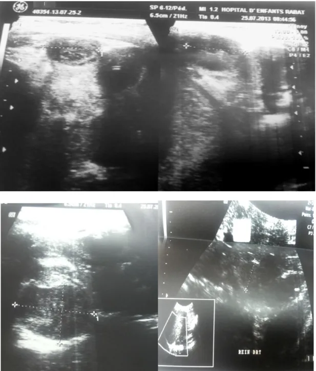 Figure 1 : Echographie abdominale (25/07/2013) montrant les nodules rénaux à droite et à  gauche