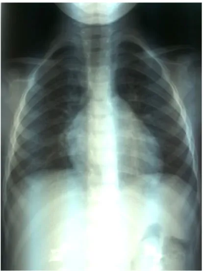Figure 3 : radiographie thoracique normale du 26/07/2013. 