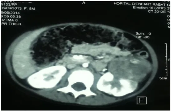 Figure 8 : TDM abdominale (06/05/2014) : progression tumorale. 