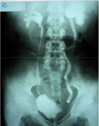 Figure 14: UIV montrant une amputation de la corne vésicale gauche avec Urétéro–