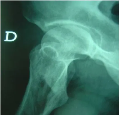 Figure  4  : Radiographie de la hanche droite, cliché de profil 