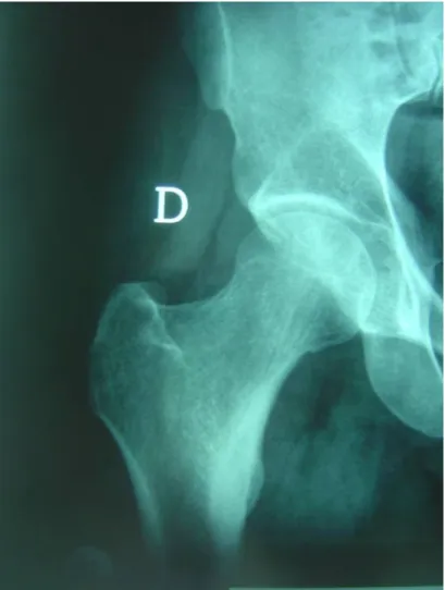 Figure  5 : Radiographie standard de la hanche droite, cliché de face 