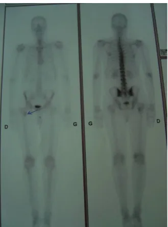 Figure  7 : scintigraphie osseuse 