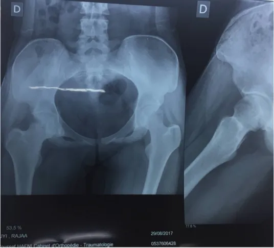 Figure  9 :  Radiographie de la hanche droite montrant une image lacunaire de la tête fémorale