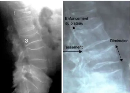 Figure 2 : Gauche : Radiographie d'une colonne vertébrale ostéoporotique, montrant  des fractures de compression au niveau des corps vertébraux L1 et L3